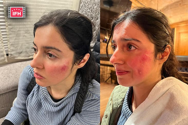 Divya Khosla Kumar Injured During The Shooting, Shares Photos.